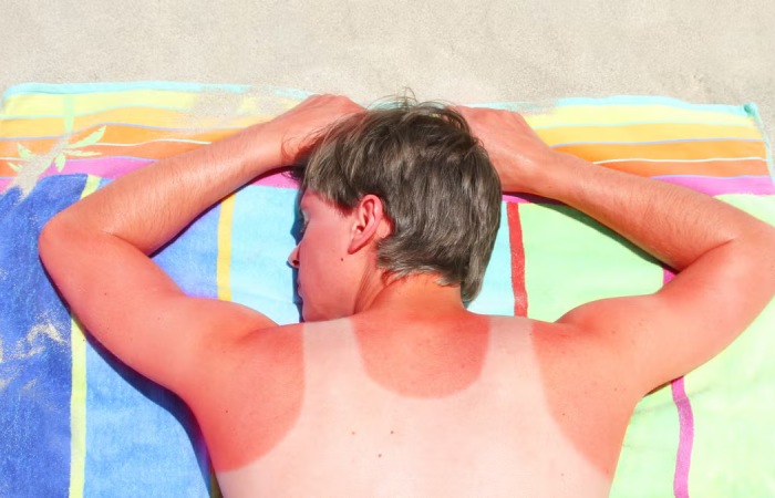 How to Prevent a burn_ 5 Tips to Stay Sun-Safe